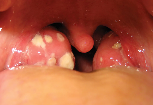 Everything You Need to Know About Acute Tonsillitis